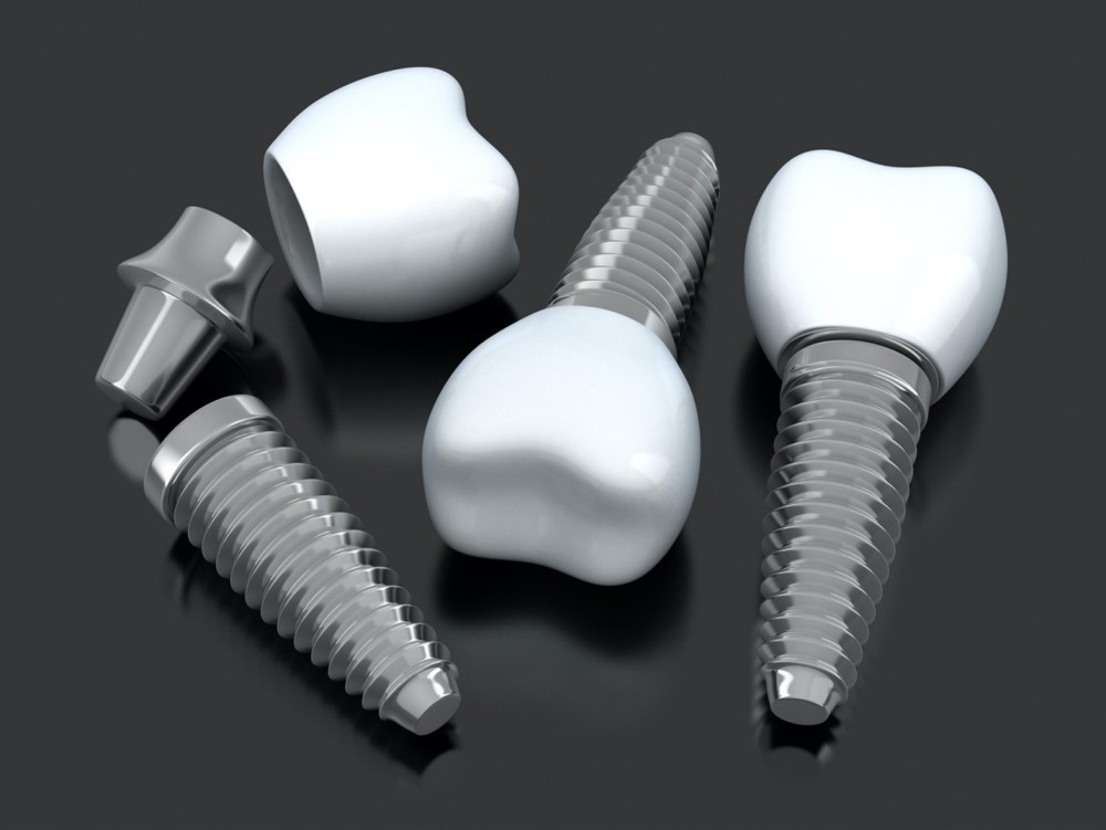 Bel-Red Best Smiles - Can You Damage your Dental Implant
